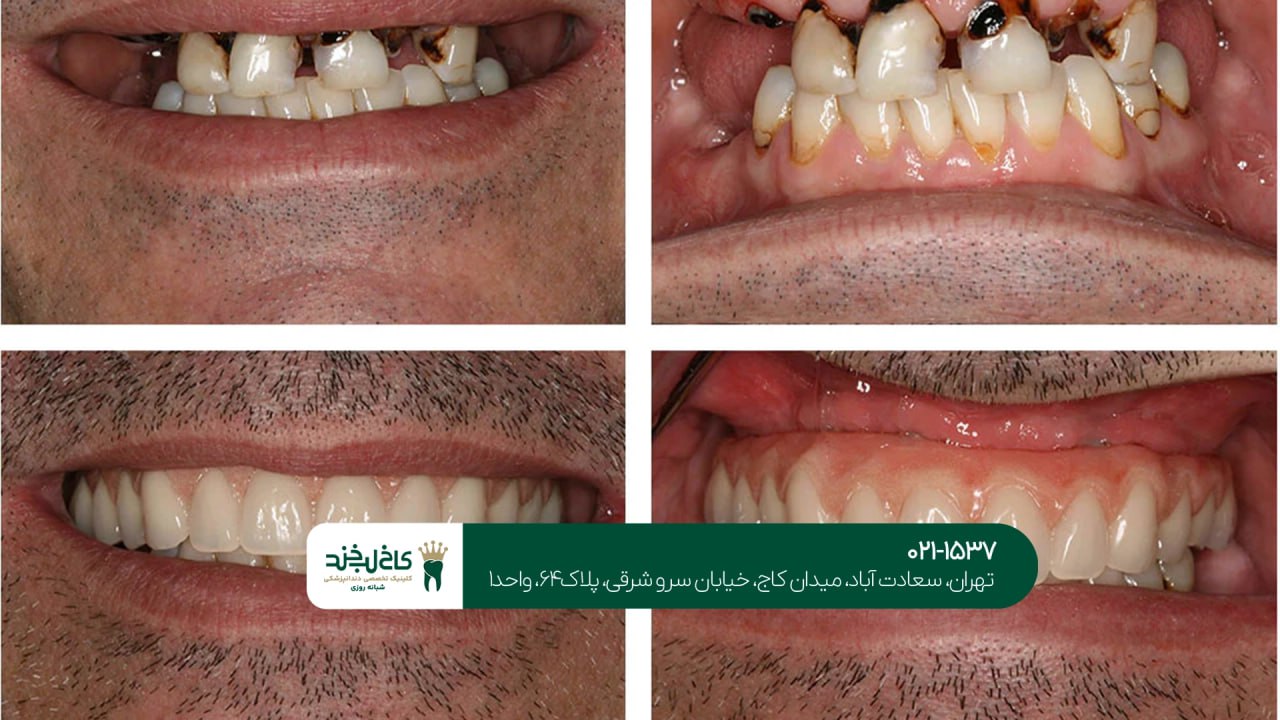 ایمپلنت فوری فک بالا و پایین ایمپلنت فوری فک بالا و پایین