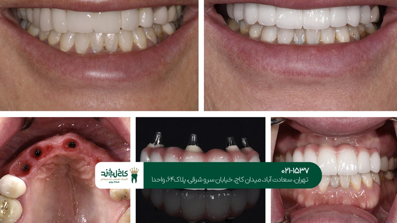 ایمپلنت فوری فک بالا و پایین ایمپلنت فوری فک بالا و پایین