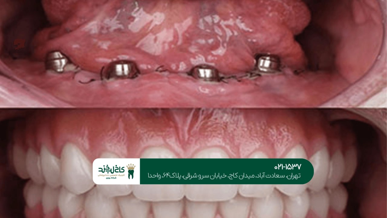 ایمپلنت فوری فک بالا و پایین ایمپلنت فوری فک بالا و پایین