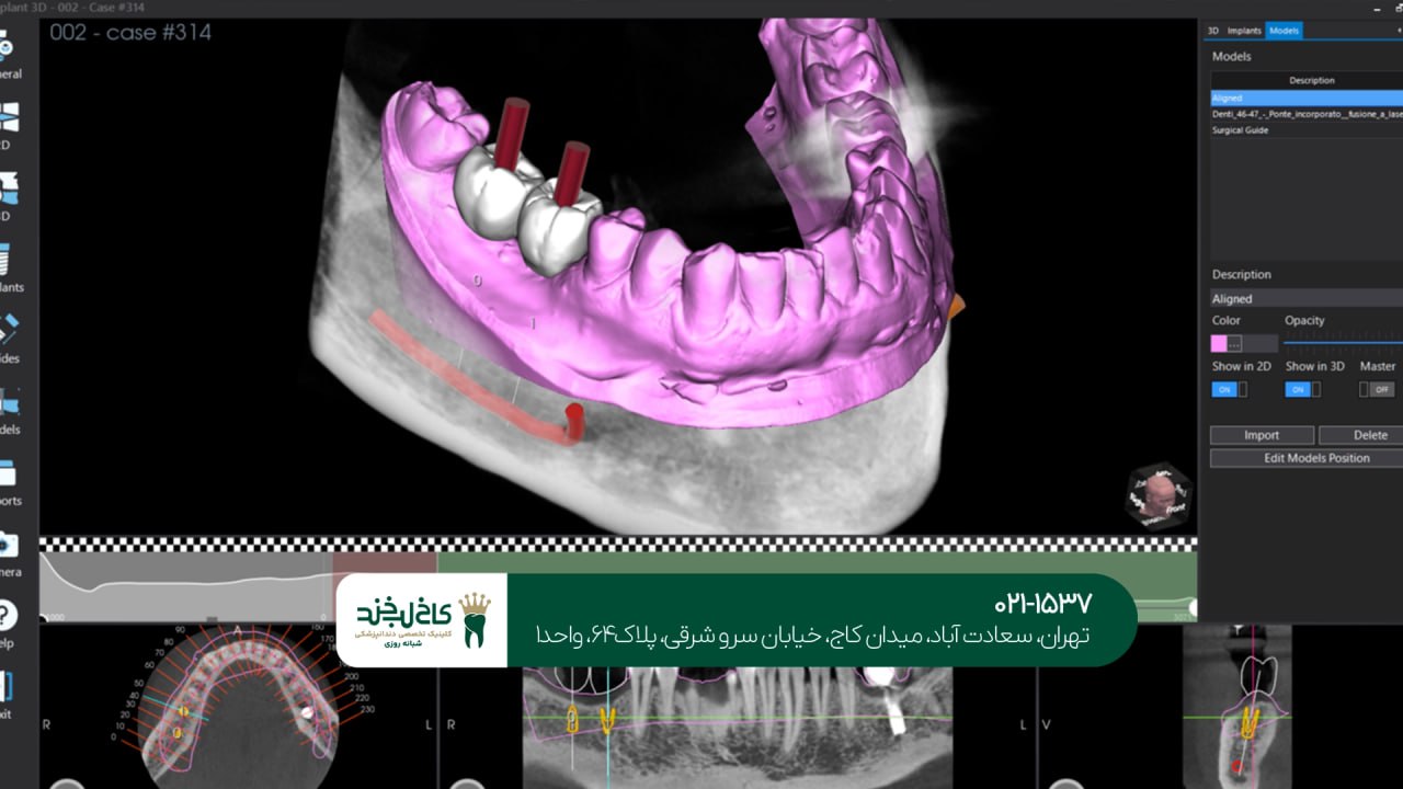 مراحل انجام ایمپلنت دیجیتال مراحل انجام ایمپلنت دیجیتال