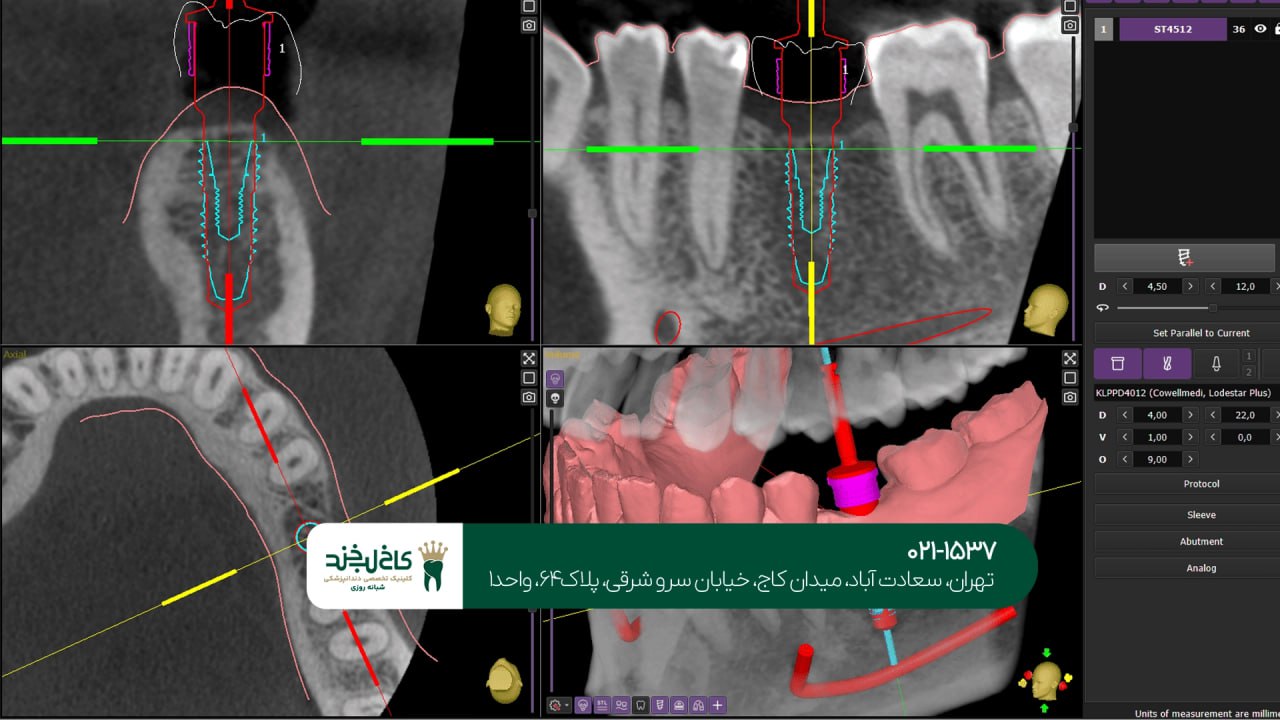 مراحل انجام ایمپلنت دیجیتال مراحل انجام ایمپلنت دیجیتال