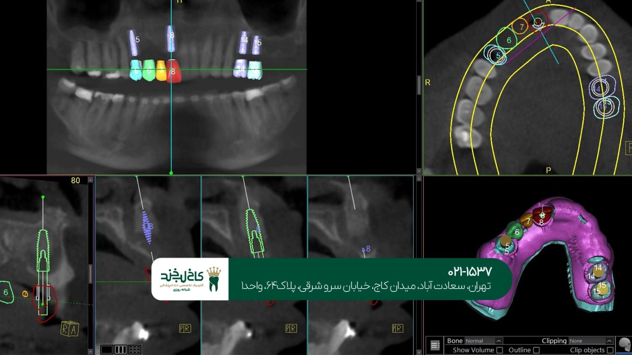 مراحل انجام ایمپلنت دیجیتال مراحل انجام ایمپلنت دیجیتال