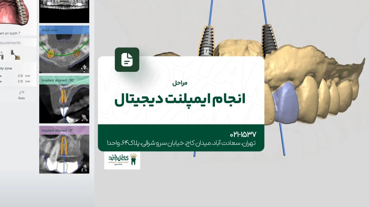 مراحل انجام ایمپلنت دیجیتال مراحل انجام ایمپلنت دیجیتال