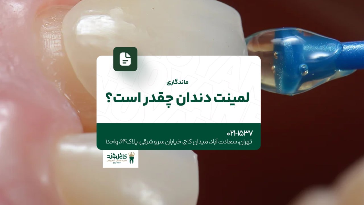 ماندگاری لمینت دندان چقدر است؟ ماندگاری لمینت دندان چقدر است؟
