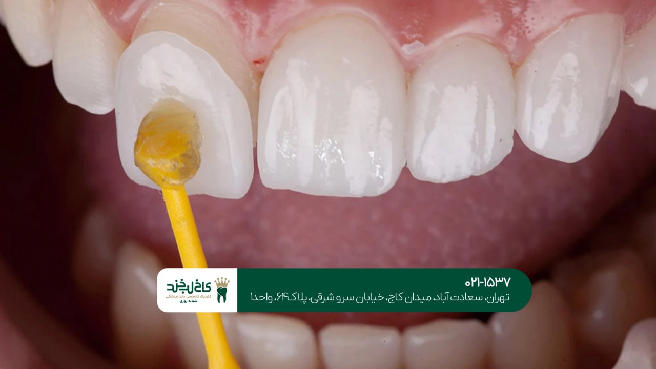 ماندگاری لمینت دندان چقدر است؟ ماندگاری لمینت دندان چقدر است؟