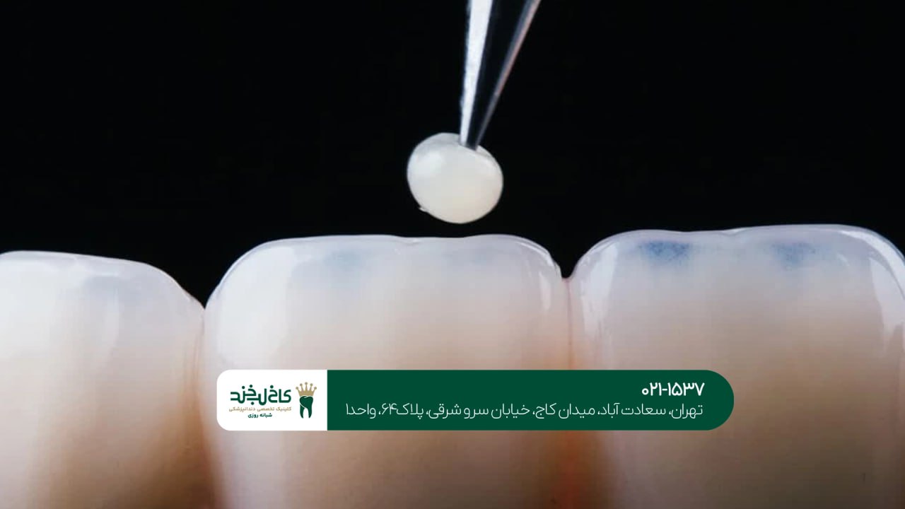 ماندگاری لمینت دندان چقدر است؟ ماندگاری لمینت دندان چقدر است؟