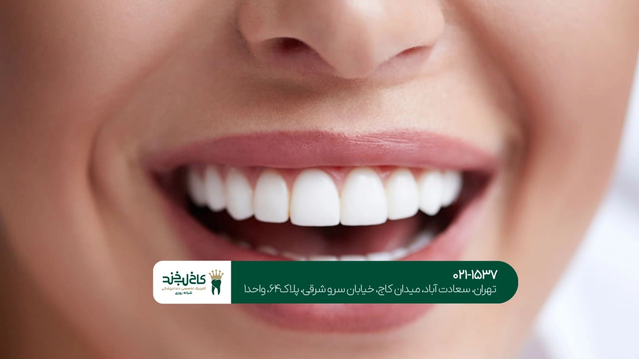 مراقبت های بعد از لمینت و کامپوزیت مراقبت های بعد از لمینت و کامپوزیت