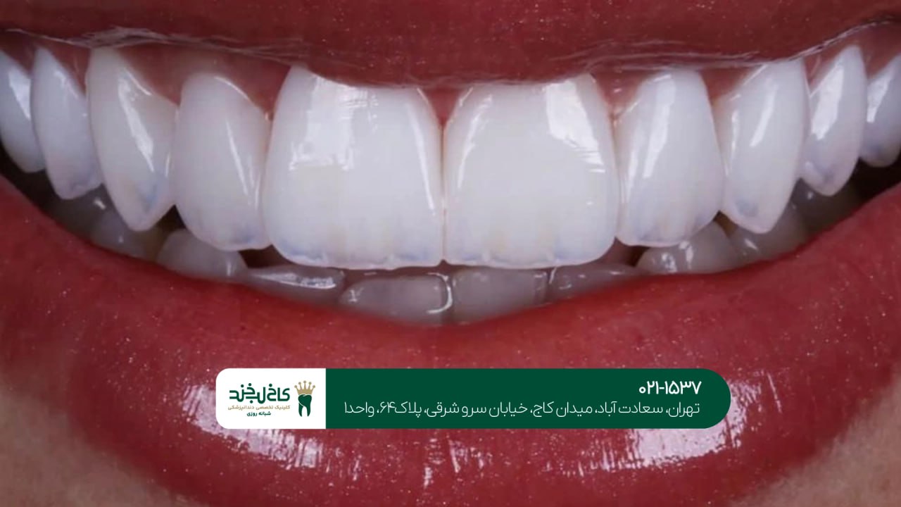 مراقبت های بعد از لمینت و کامپوزیت مراقبت های بعد از لمینت و کامپوزیت