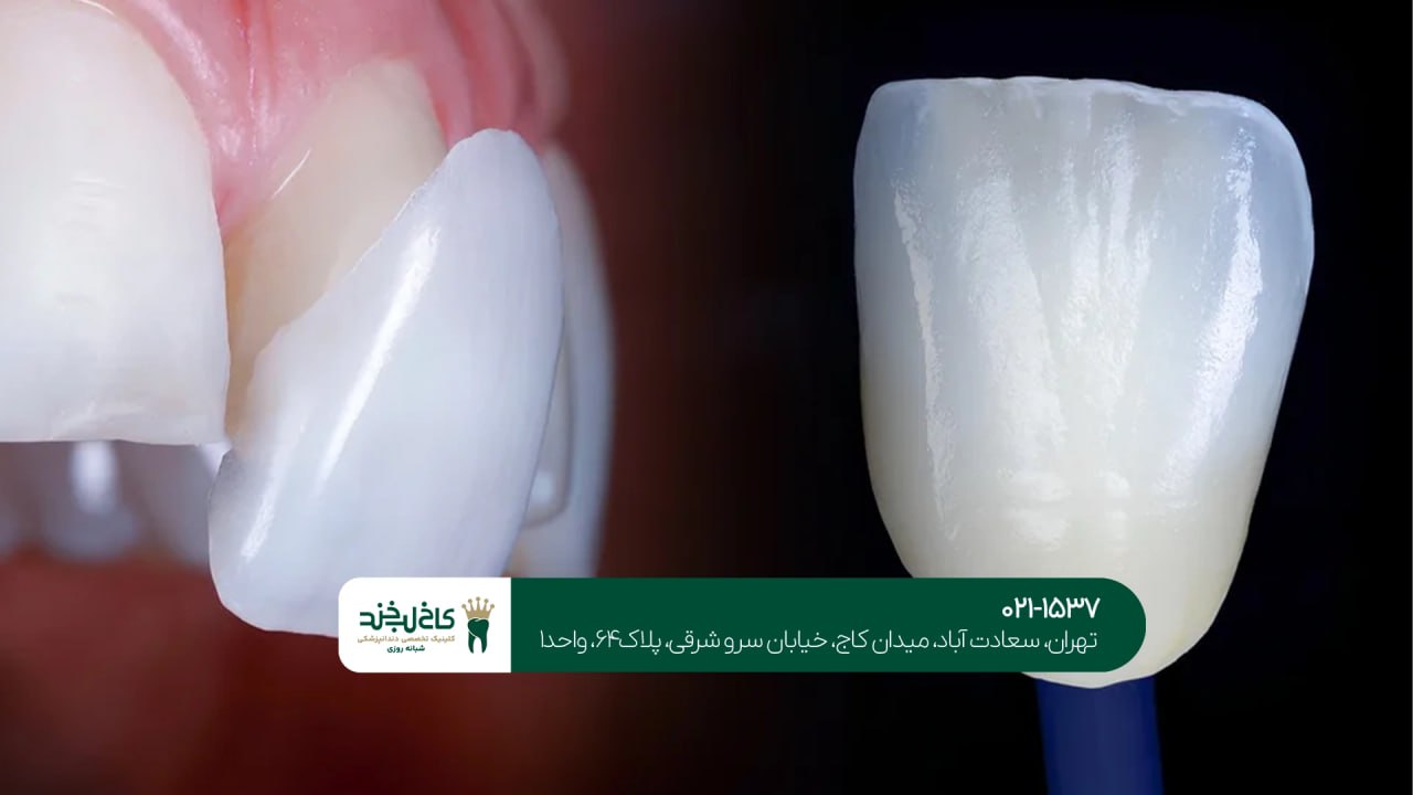 ماندگاری لمینت دندان چقدر است؟ ماندگاری لمینت دندان چقدر است؟