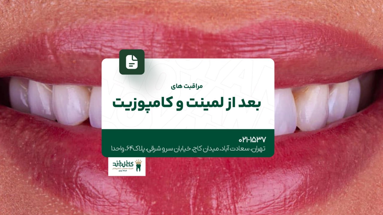 مراقبت های بعد از لمینت و کامپوزیت مراقبت های بعد از لمینت و کامپوزیت