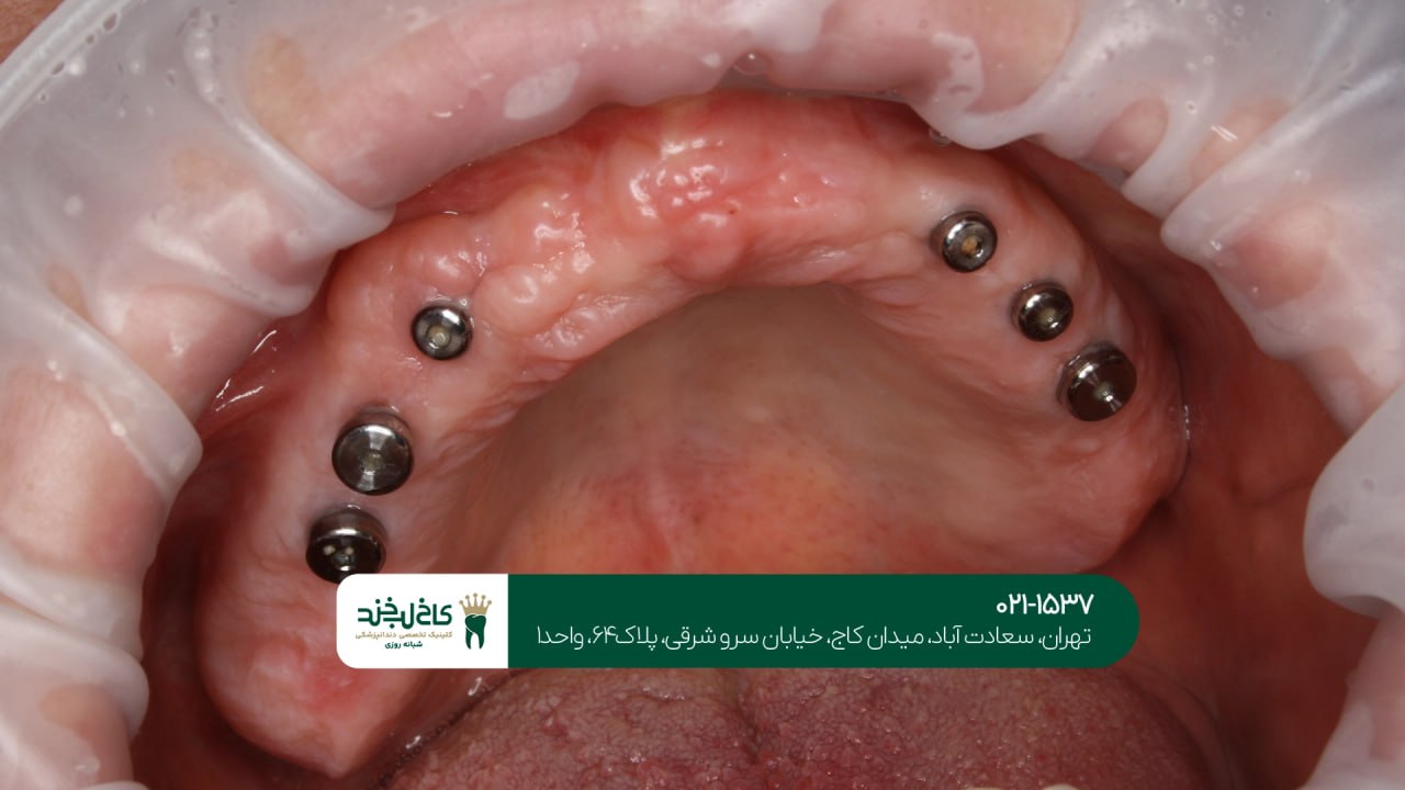 عوارض ایمپلنت دندان و روش جلوگیری عوارض ایمپلنت دندان و روش جلوگیری