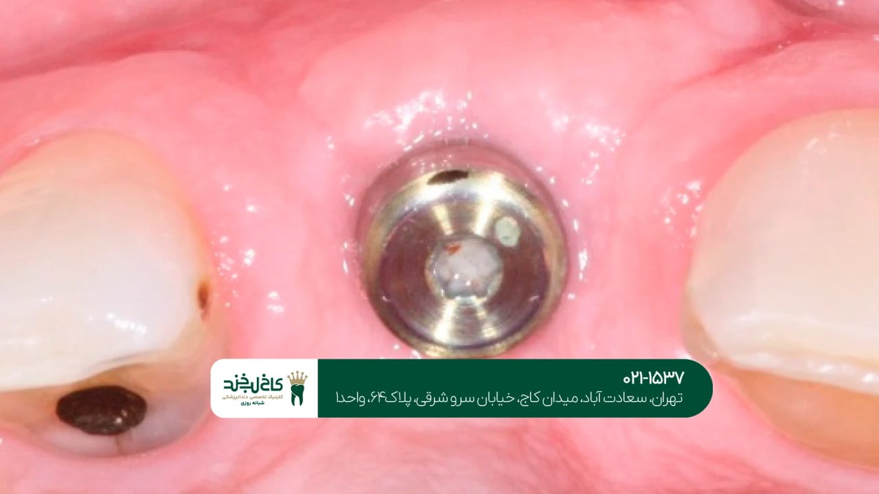 عوارض ایمپلنت دندان و روش جلوگیری عوارض ایمپلنت دندان و روش جلوگیری