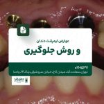 عوارض ایمپلنت دندان و روش جلوگیری