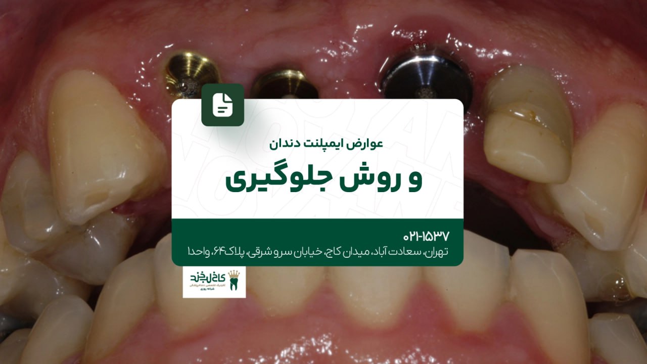 عوارض ایمپلنت دندان و روش جلوگیری عوارض ایمپلنت دندان و روش جلوگیری