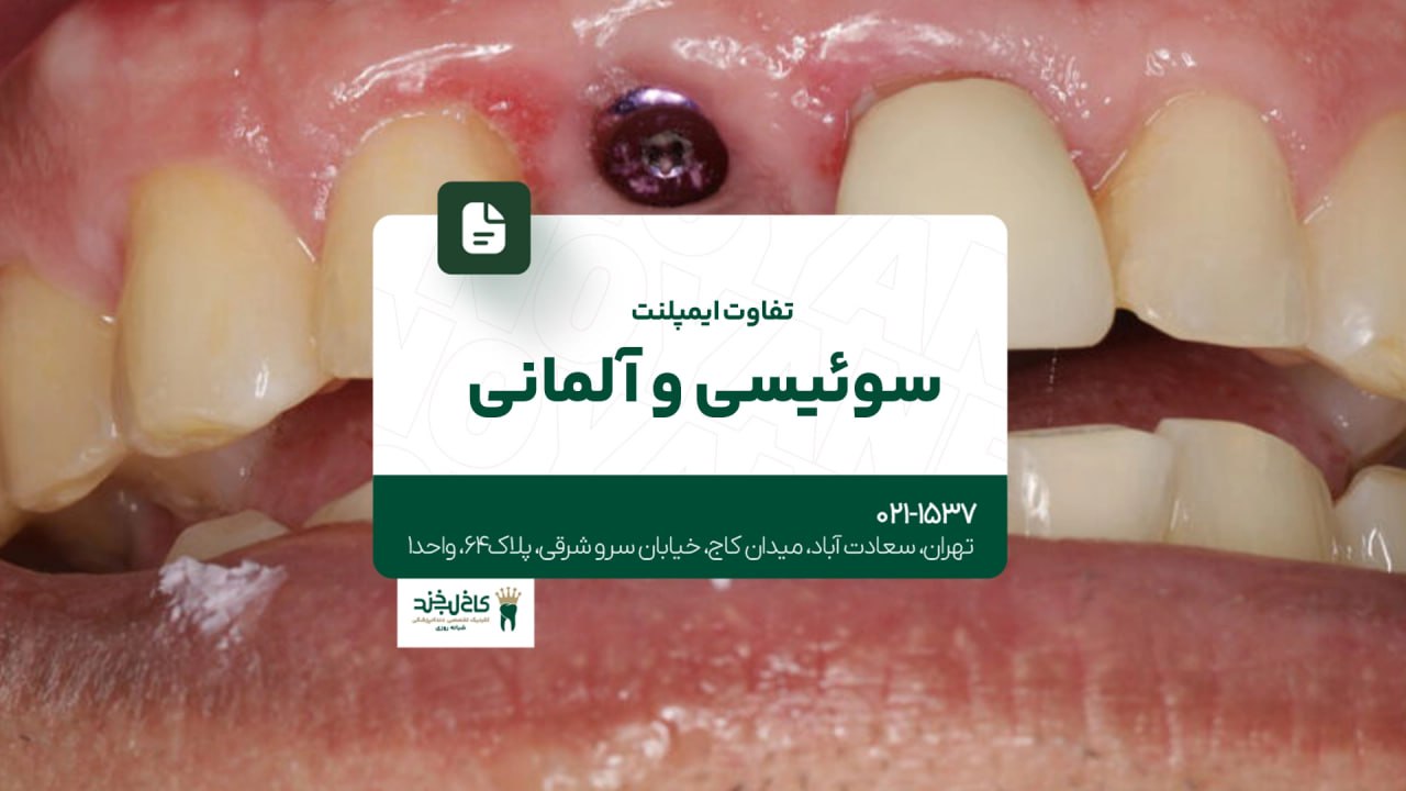 تفاوت ایمپلنت سوئیسی و آلمانی تفاوت ایمپلنت سوئیسی و آلمانی