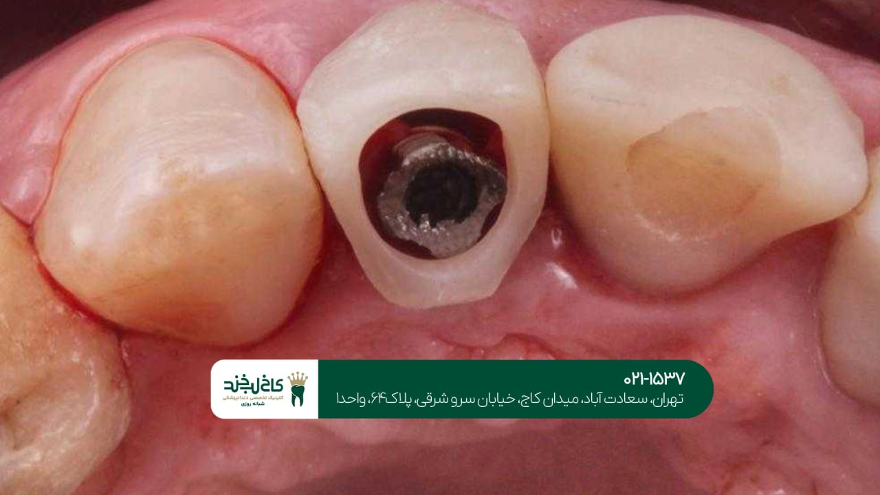 تفاوت ایمپلنت سوئیسی و آلمانی تفاوت ایمپلنت سوئیسی و آلمانی