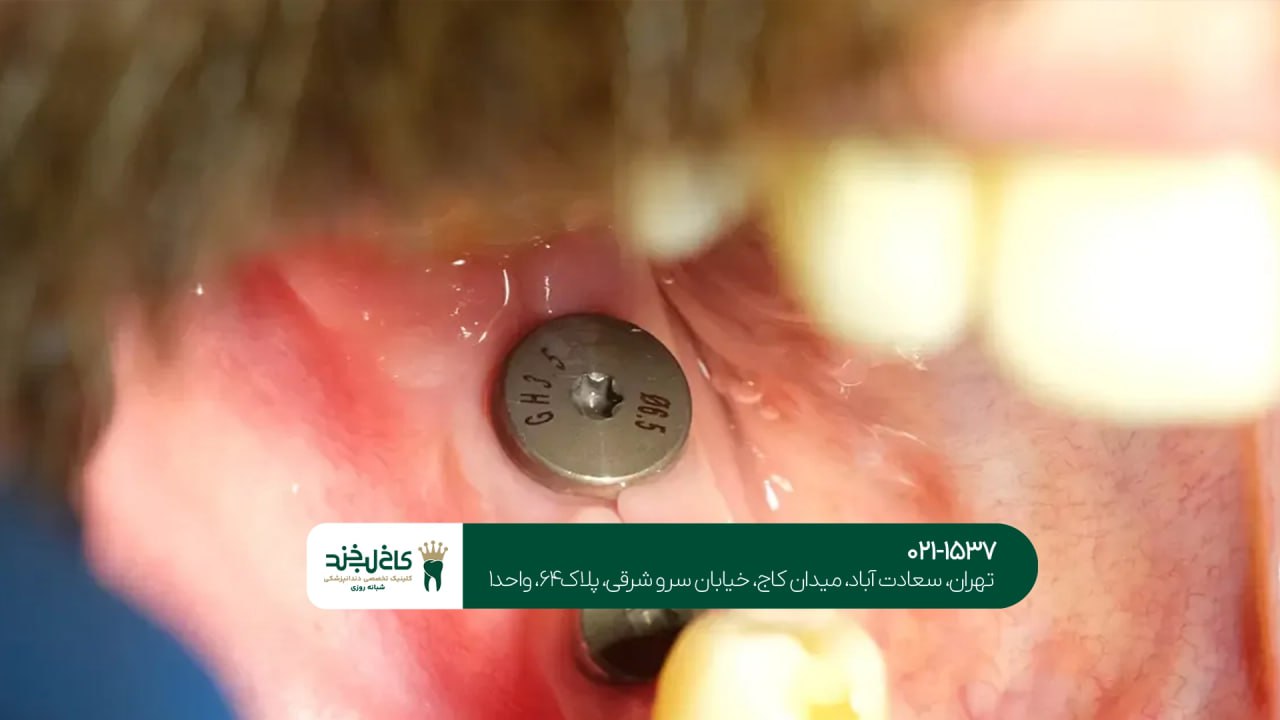 تفاوت ایمپلنت سوئیسی و آلمانی تفاوت ایمپلنت سوئیسی و آلمانی