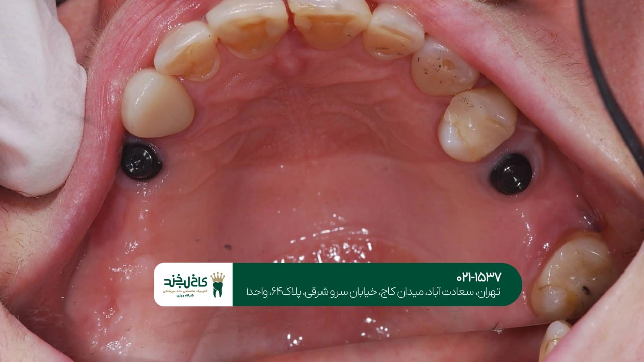 تفاوت ایمپلنت سوئیسی و آلمانی تفاوت ایمپلنت سوئیسی و آلمانی