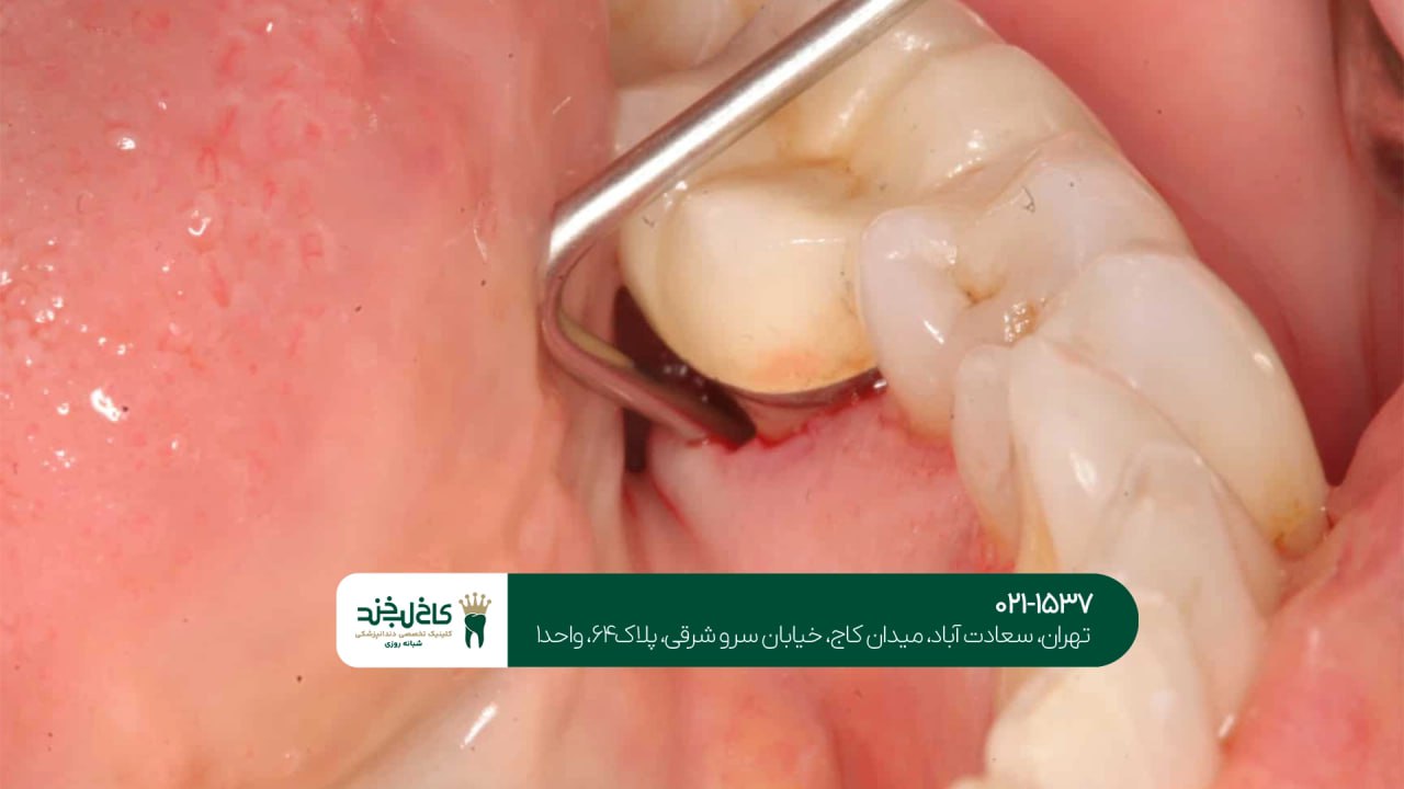 روش های جلوگیری از عفونت بعد از جراحی روش های جلوگیری از عفونت بعد از جراحی
