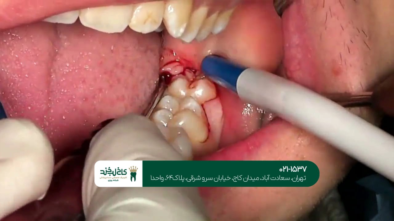 روش های جلوگیری از عفونت بعد از جراحی روش های جلوگیری از عفونت بعد از جراحی