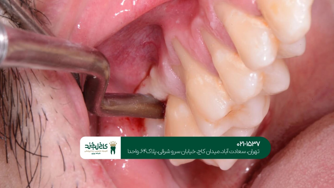روش های جلوگیری از عفونت بعد از جراحی روش های جلوگیری از عفونت بعد از جراحی