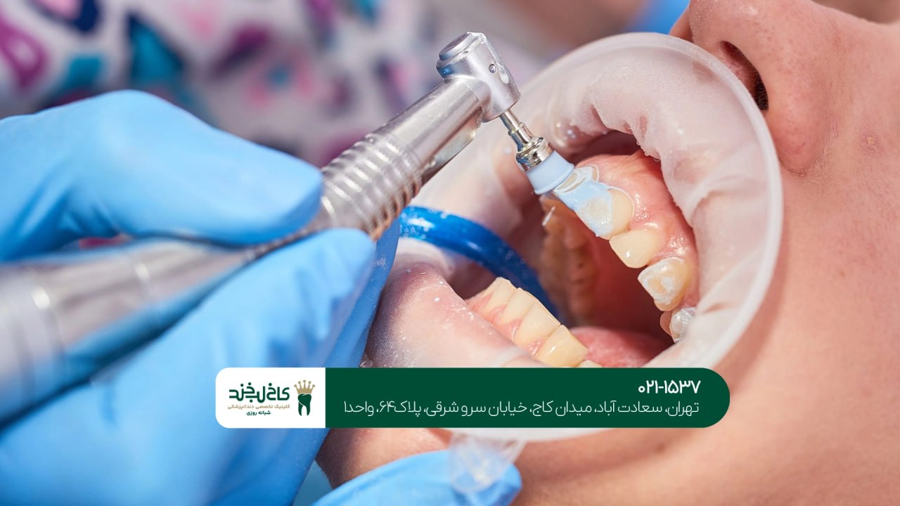 جرم گیری و بلیچینگ دندان با هم جرم گیری و بلیچینگ دندان با هم