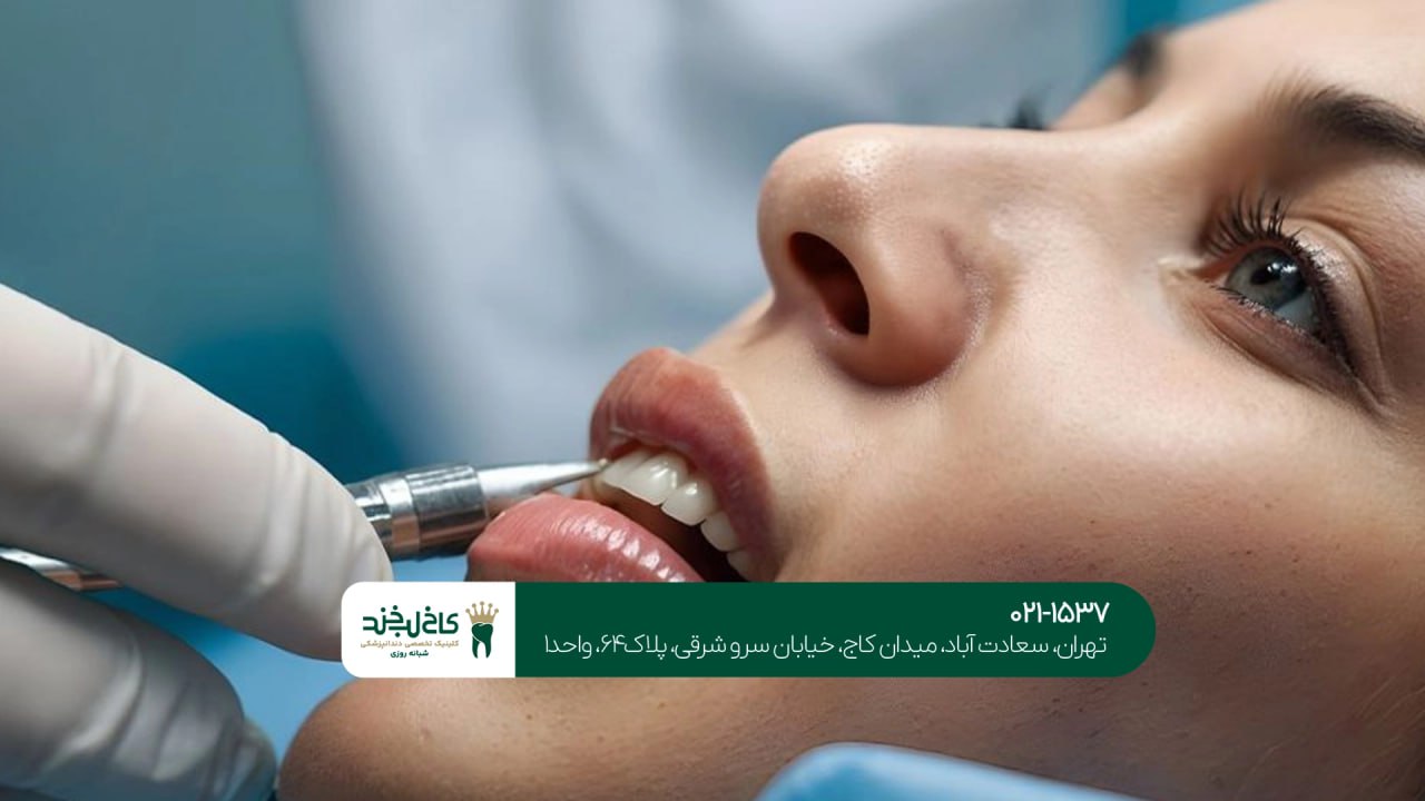 جرم گیری و بلیچینگ دندان با هم جرم گیری و بلیچینگ دندان با هم