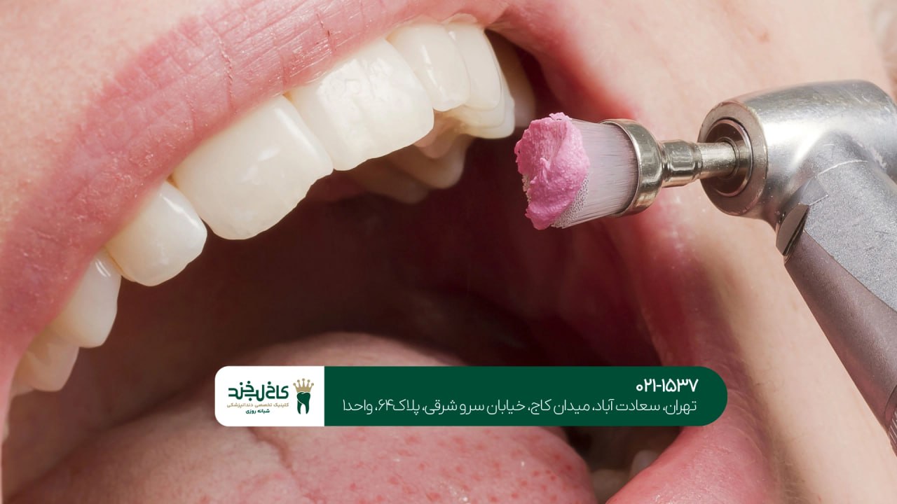 جرم گیری و بلیچینگ دندان با هم جرم گیری و بلیچینگ دندان با هم