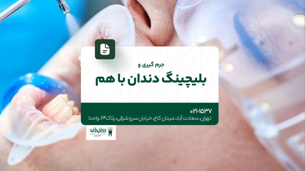 جرم گیری و بلیچینگ دندان با هم جرم گیری و بلیچینگ دندان با هم