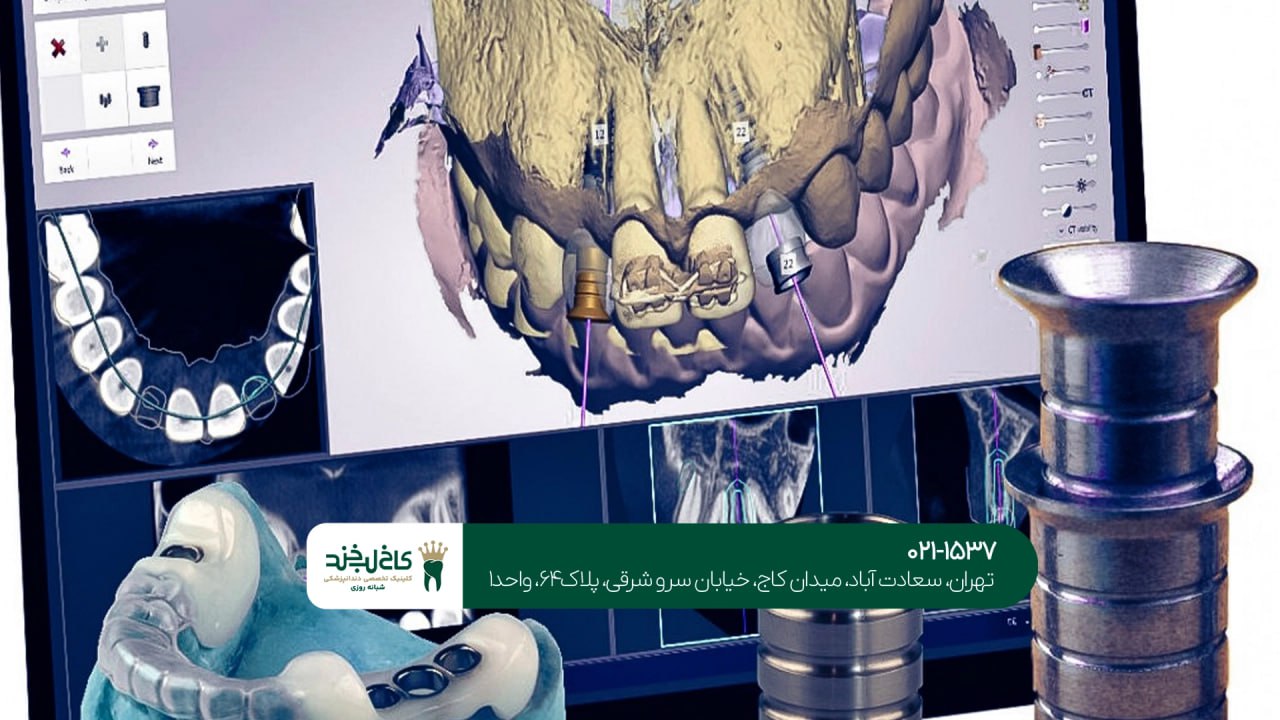 ایمپلنت دیجیتال با دستگاه اسکن داخل دهانی ایمپلنت دیجیتال با دستگاه اسکن داخل دهانی