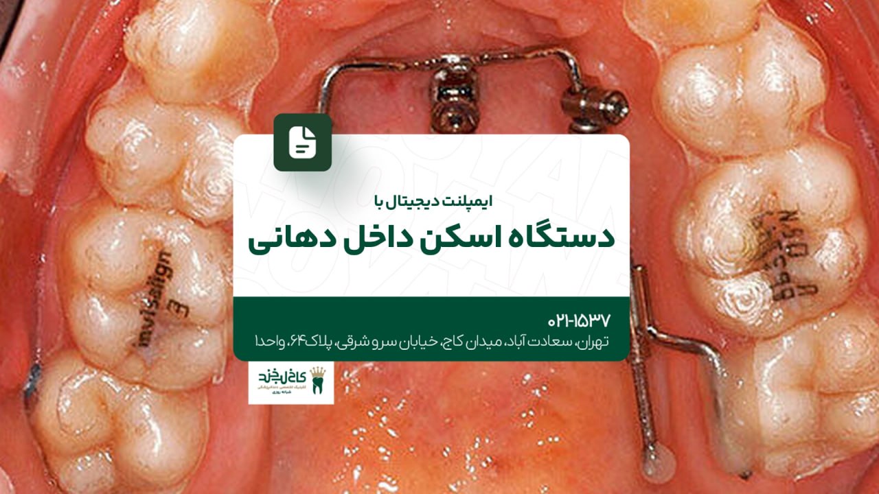 ایمپلنت دیجیتال با دستگاه اسکن داخل دهانی ایمپلنت دیجیتال با دستگاه اسکن داخل دهانی