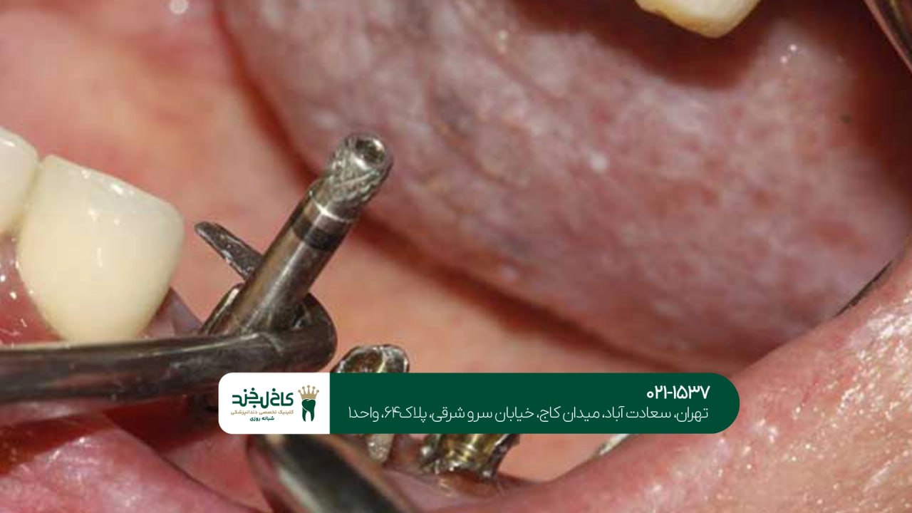 ایمپلنت دندان با تکنولوژی دیجیتال ایمپلنت دندان با تکنولوژی دیجیتال