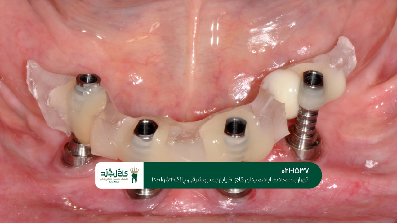 ایمپلنت دندان با تکنولوژی دیجیتال ایمپلنت دندان با تکنولوژی دیجیتال