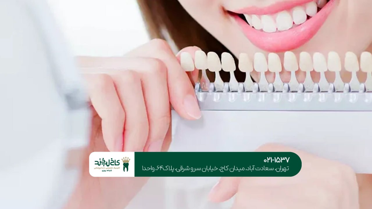 هزینه لمینت دندان در شمال تهران هزینه لمینت دندان در شمال تهران