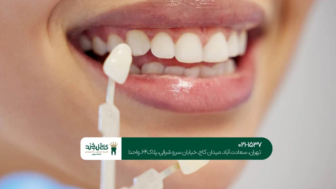 هزینه لمینت دندان در شمال تهران هزینه لمینت دندان در شمال تهران