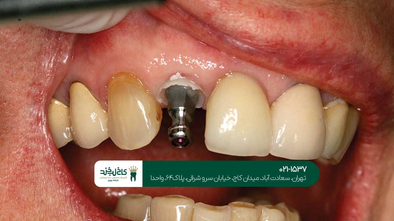 ایمپلنت اقساطی در جردن ایمپلنت اقساطی در جردن