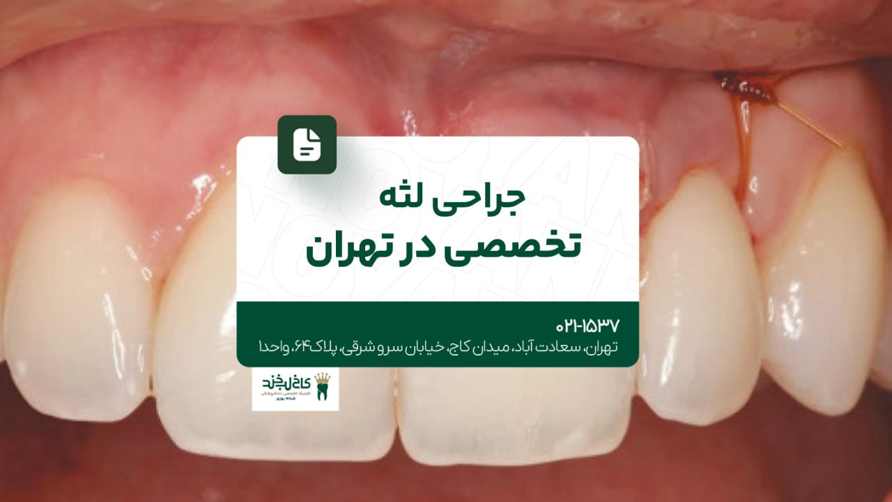 جراحی لثه تخصصی در تهران جراحی لثه تخصصی در تهران