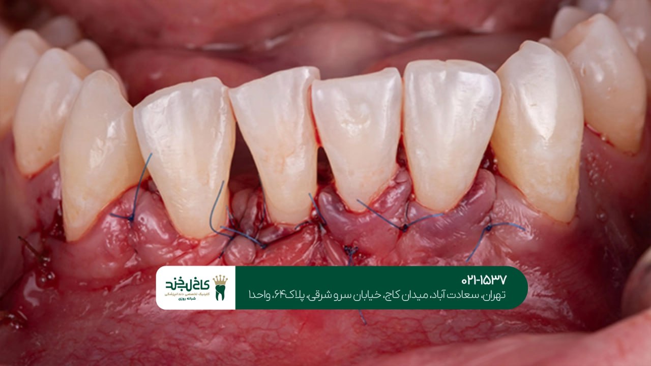 جراحی لثه تخصصی در تهران جراحی لثه تخصصی در تهران