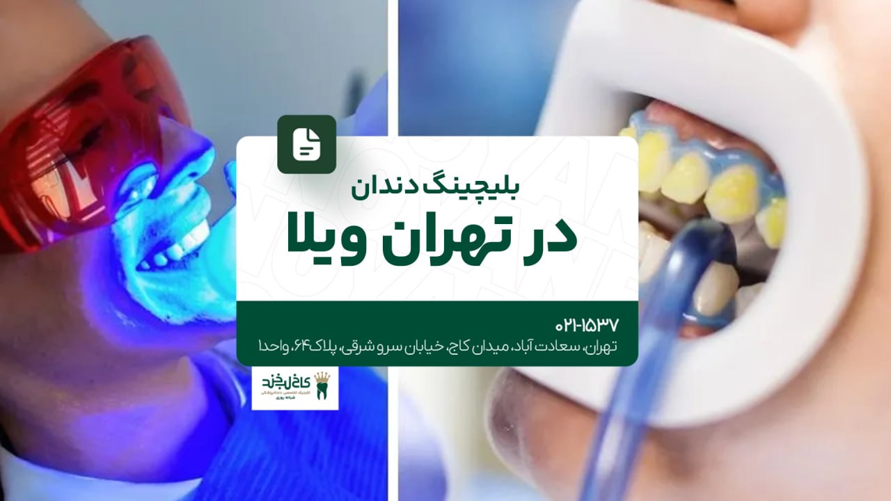 بلیچینگ دندان در تهران ویلا بلیچینگ دندان در تهران ویلا