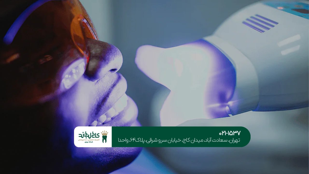 بلیچینگ دندان در تهران ویلا بلیچینگ دندان در تهران ویلا