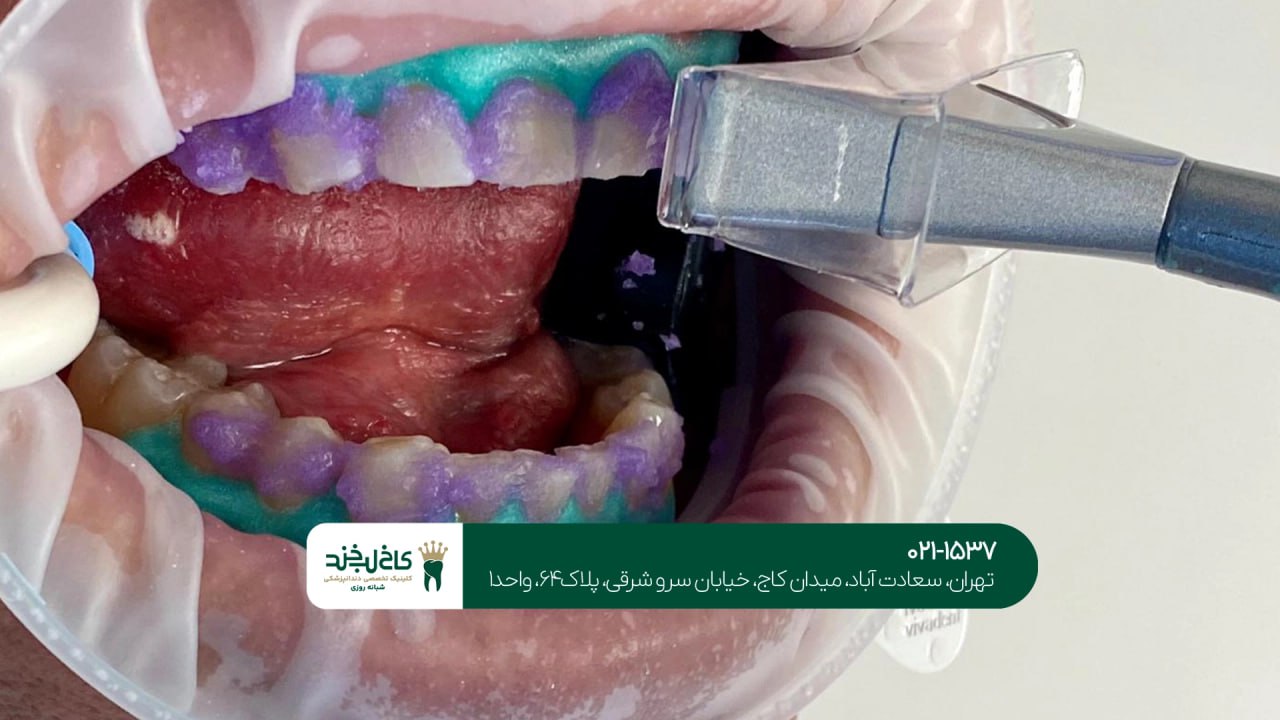 بلیچینگ دندان در تهران ویلا بلیچینگ دندان در تهران ویلا