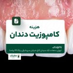 هزینه کامپوزیت دندان