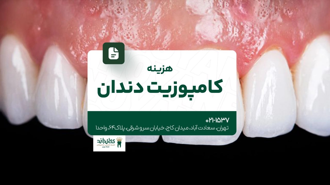 هزینه کامپوزیت دندان هزینه کامپوزیت دندان