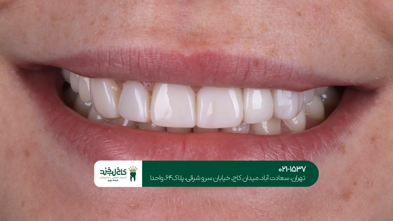 هزینه کامپوزیت دندان هزینه کامپوزیت دندان