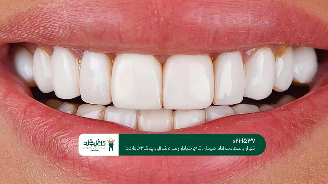 هزینه کامپوزیت دندان هزینه کامپوزیت دندان