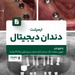 ایمپلنت دندان دیجیتال