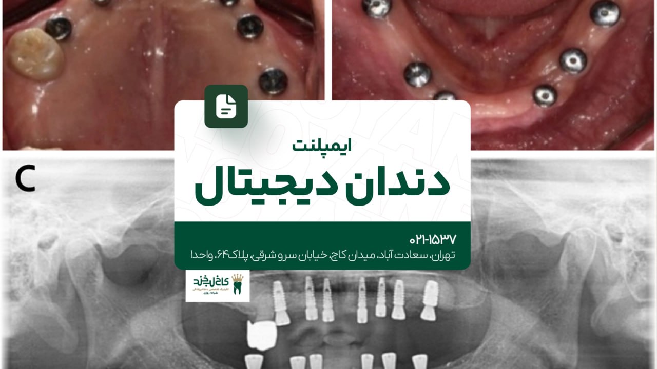 ایمپلنت دندان دیجیتال ایمپلنت دندان دیجیتال