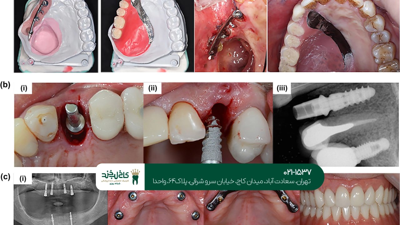 ایمپلنت دندان دیجیتال ایمپلنت دندان دیجیتال