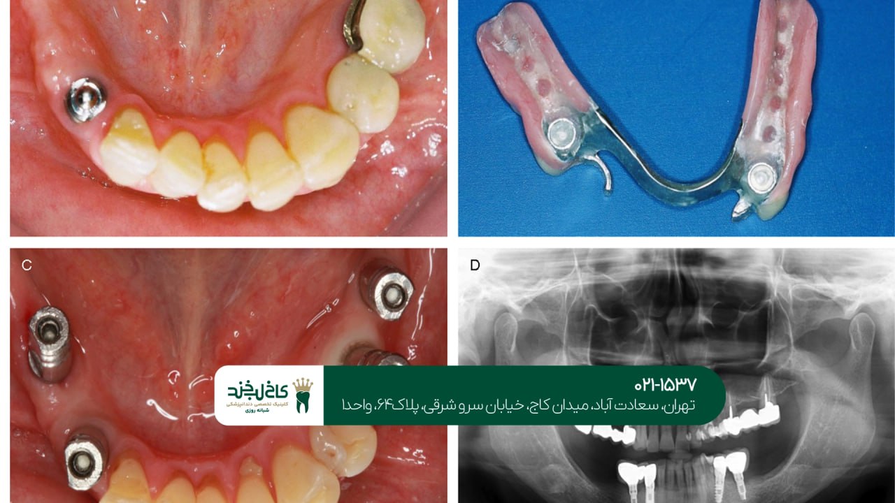 ایمپلنت دندان دیجیتال ایمپلنت دندان دیجیتال