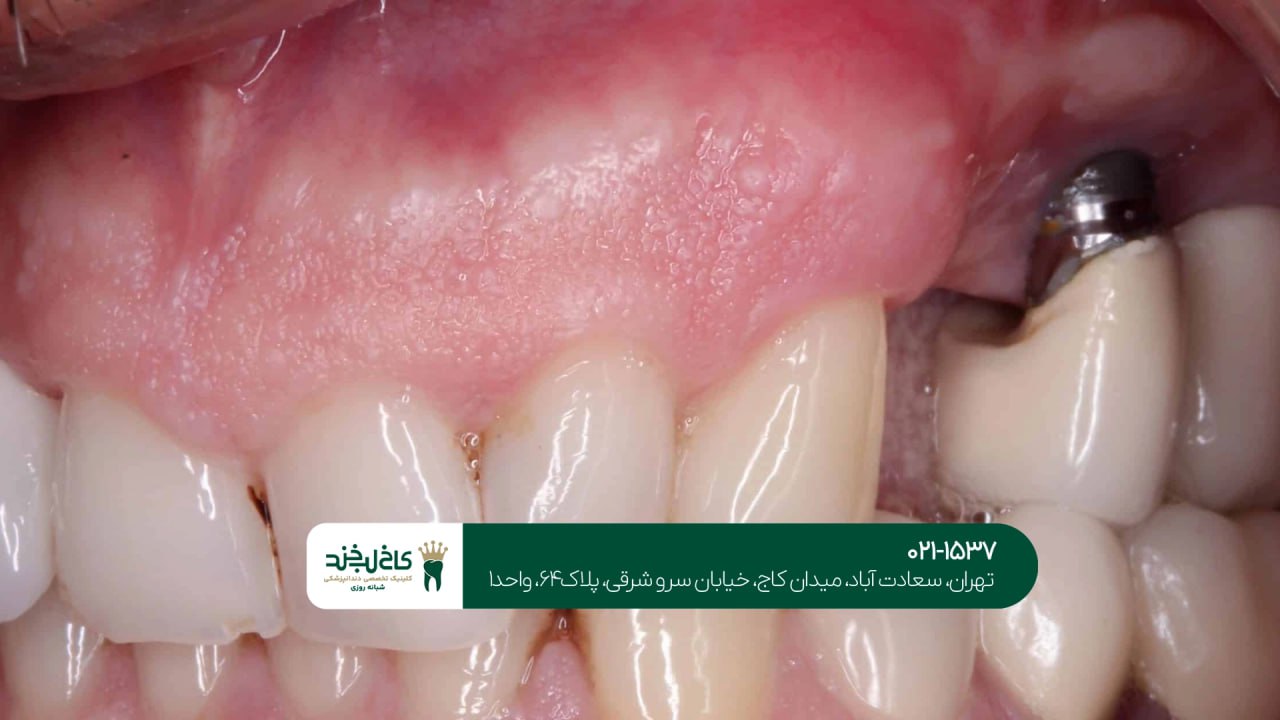 درمان ایمپلنت بدون درد درمان ایمپلنت بدون درد